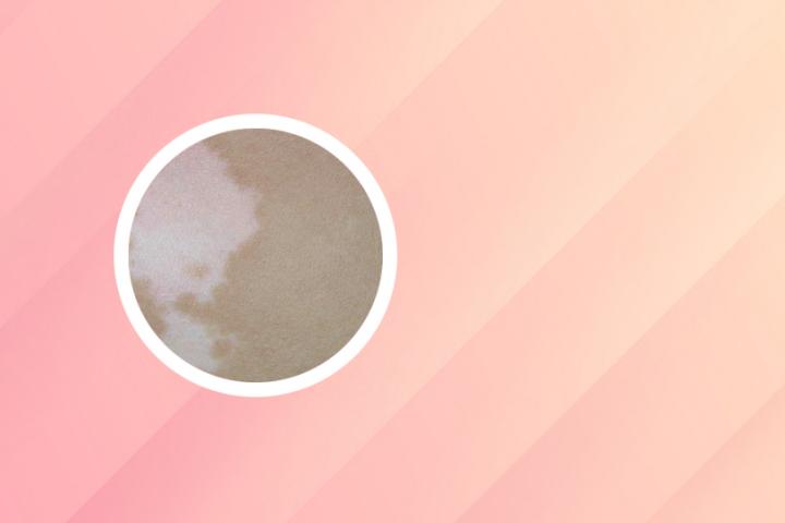 uvb对白癜风有效吗