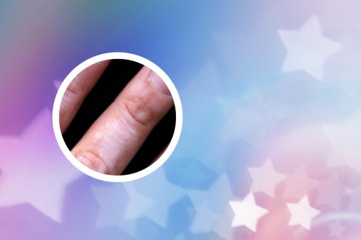 河南白癜风治疗费用多少