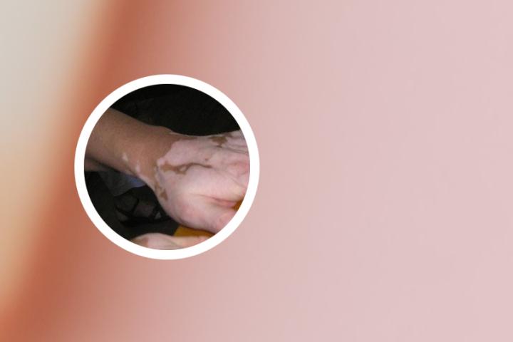 看白癜风联系西安