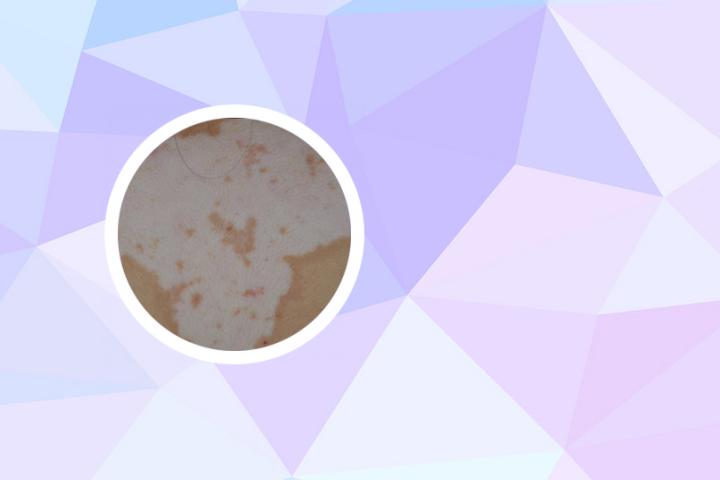 倪海厦白癜风经方