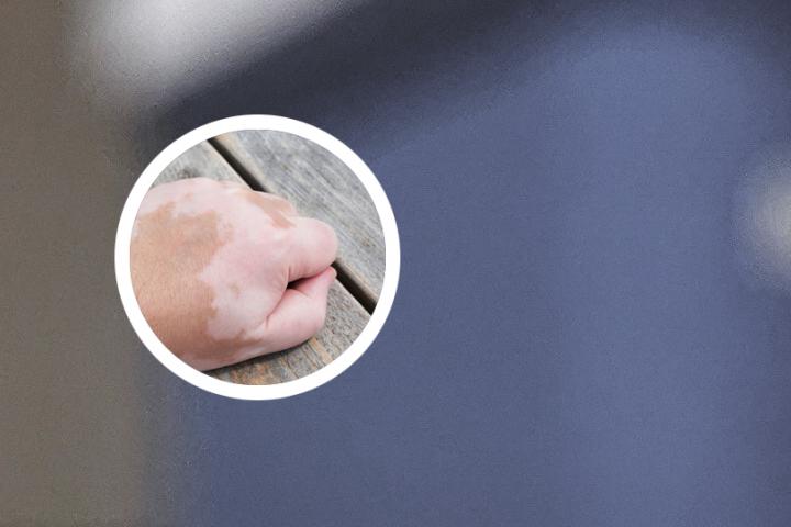 白癜风扩散打什么针