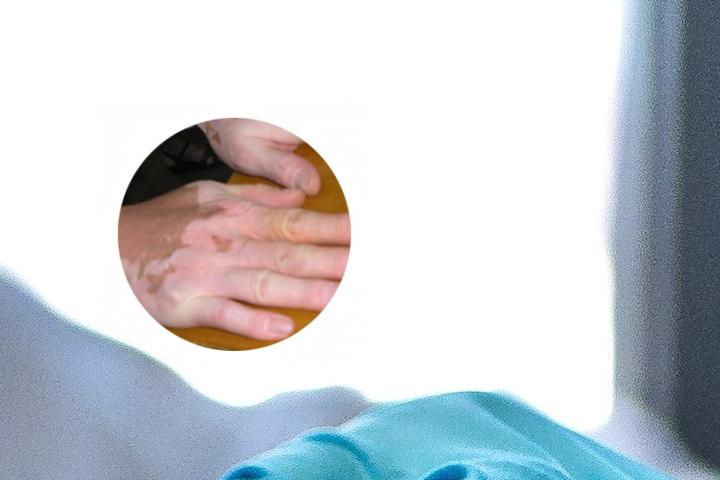 白癜风仪器治疗起黑点
