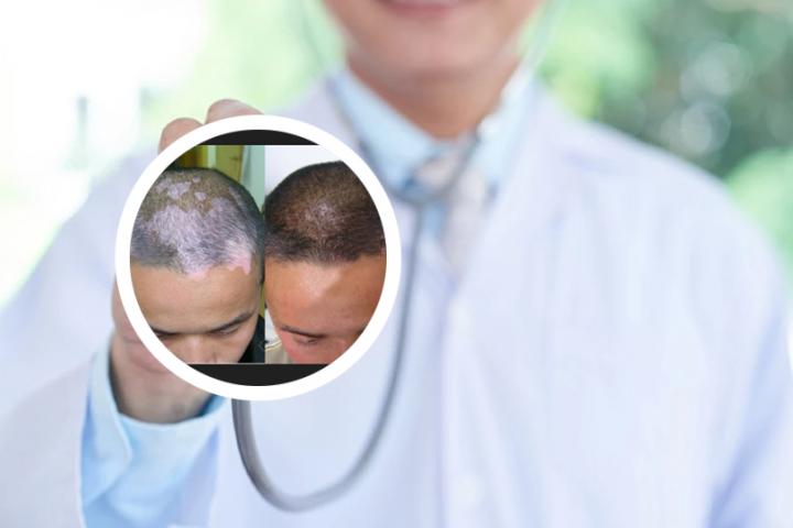 肤宝灵软膏能治白癜风吗