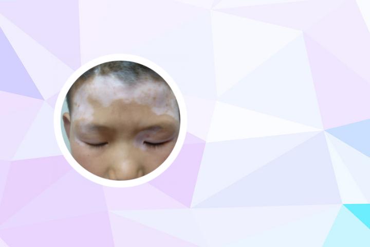 白癜风晚上吃什么饭最好