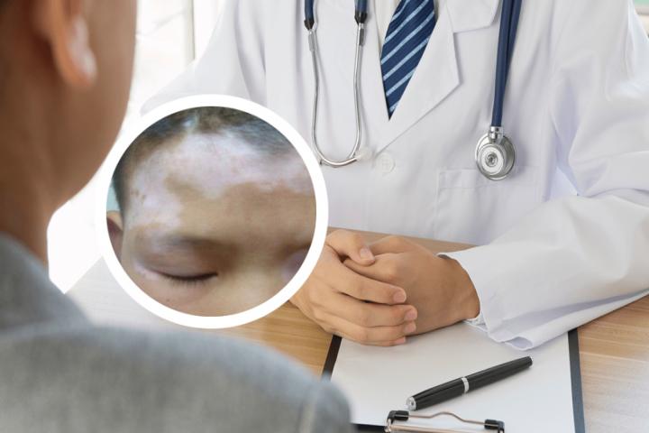 白癜风照光治疗是什么
