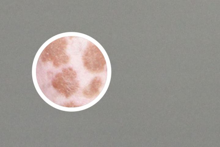 usana葆婴调理白癜风
