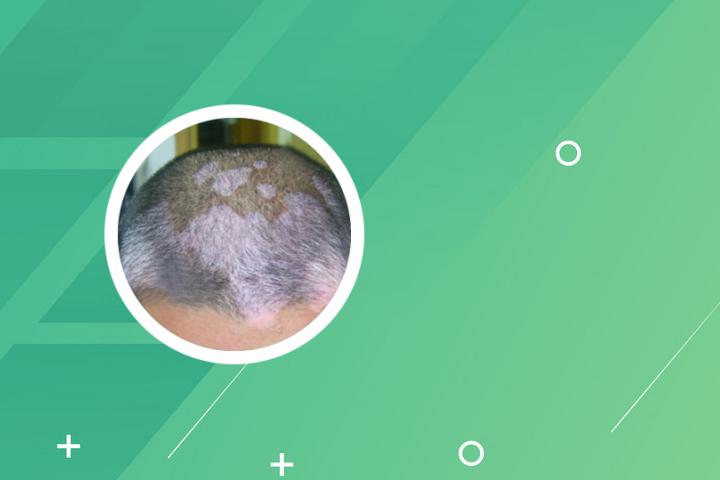 白癜风患者能吃花椒