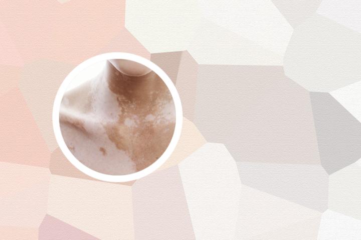 额头白癜风医院治疗