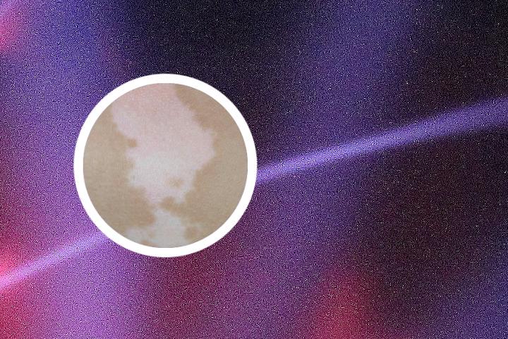 推拿治疗白癜风方法