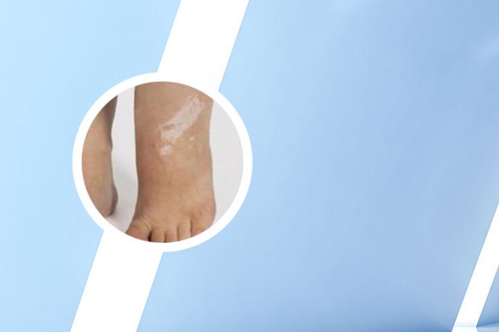 小孩有白癜风能治疗吗