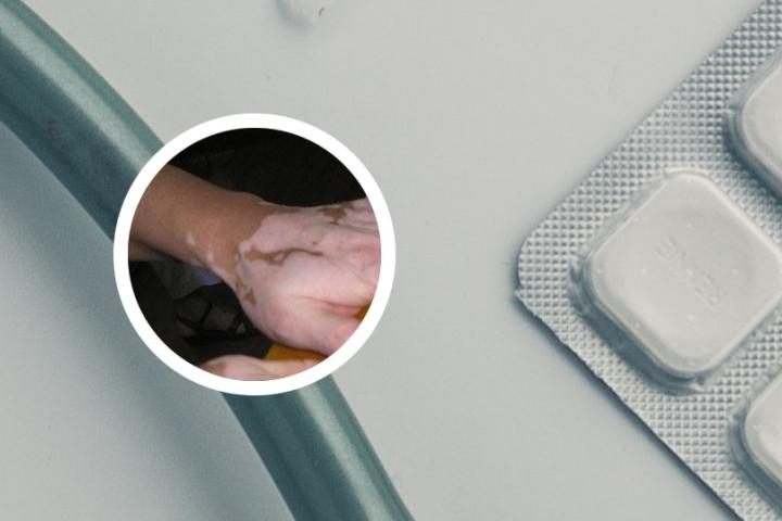 白癜风有没有最新治疗方法