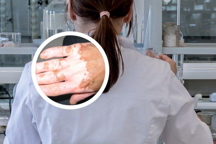 白癜风患者可食用葡萄籽吗