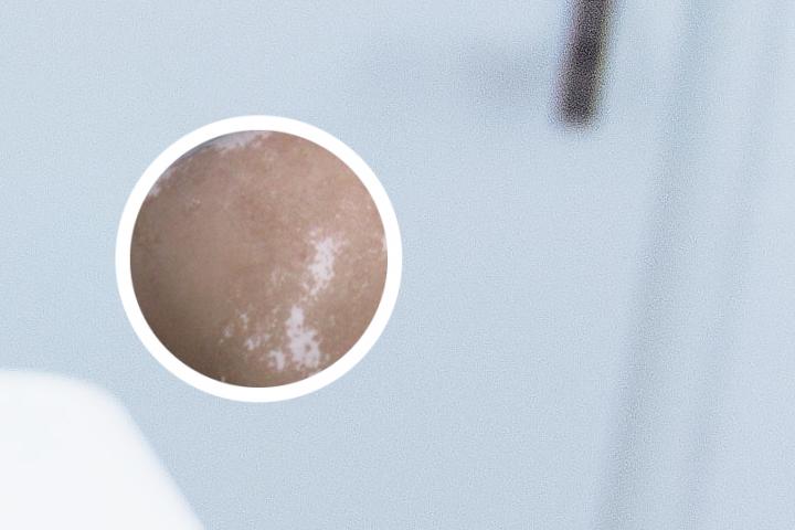 白癜风腰椎突出