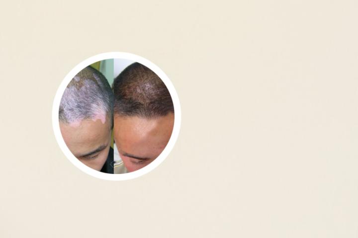 硼酸洗液可以洗白癜风吗