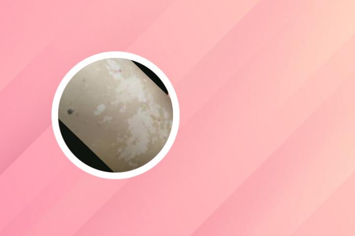 大蒜对白癜风有影响吗