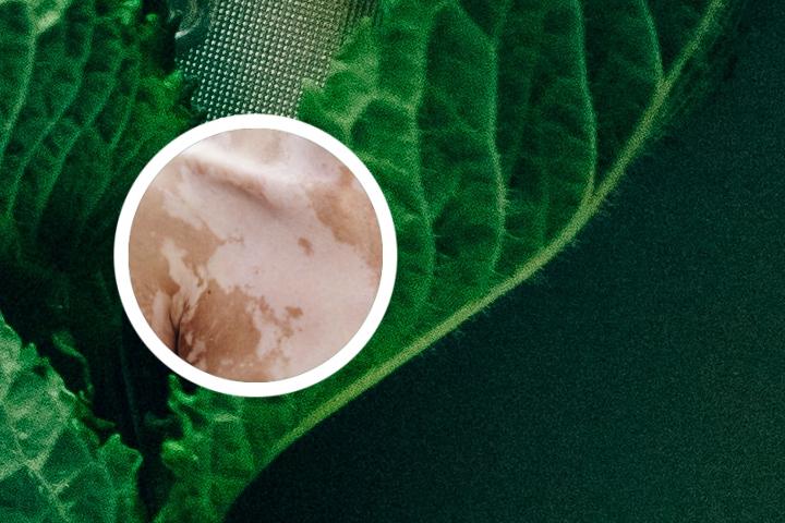 杭州哪治疗白癜风好