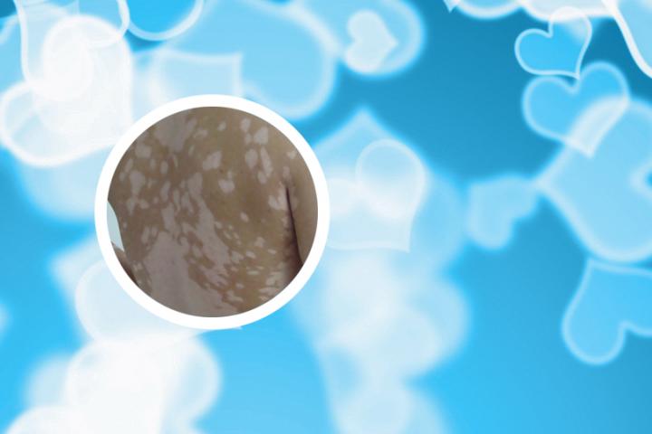 得了白癜风还可以健身吗