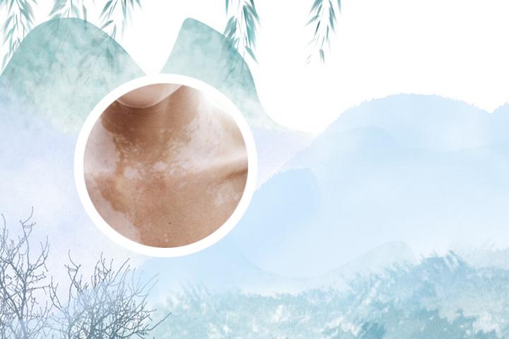 疏通经络可以治白癜风吗