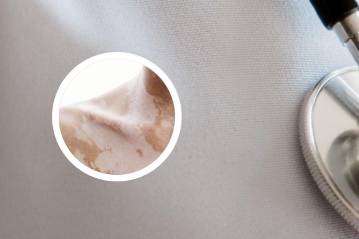 白点灵可以治疗白癜风