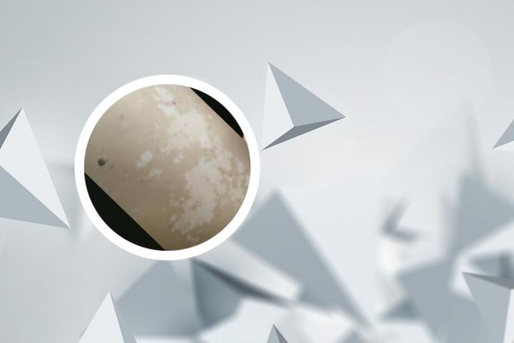 白癜风能通过教师体检吗