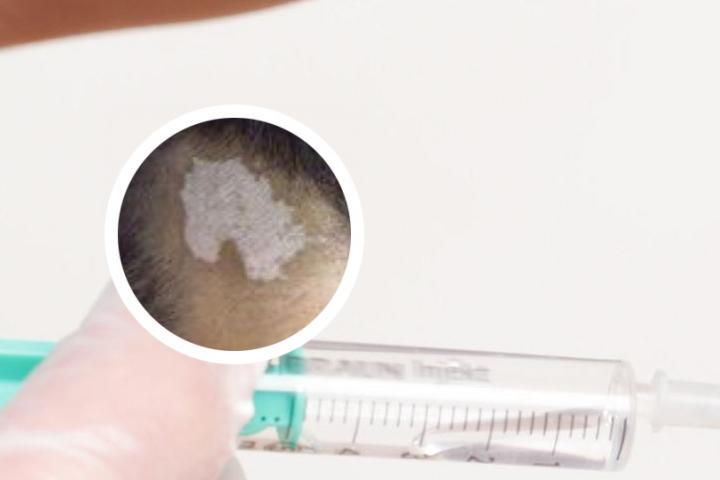 洋葱泡醋能治疗白癜风吗