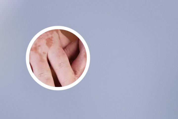 白癜风人头发不会白吗