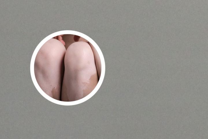 白癜风病人用的东西