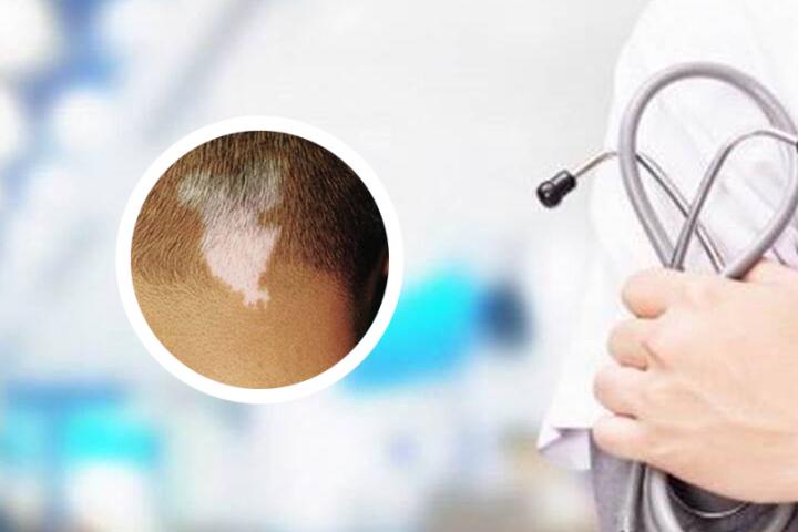 全国白癜风患病率