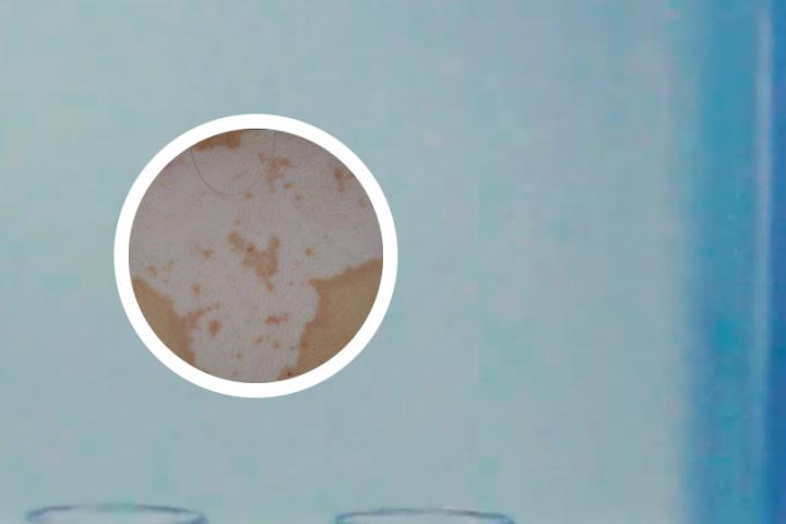 白癜风为啥不能吃维生素 白癜风为啥不能吃维生素