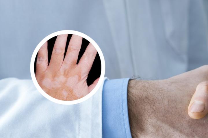 白癜风患者抽烟怎么办