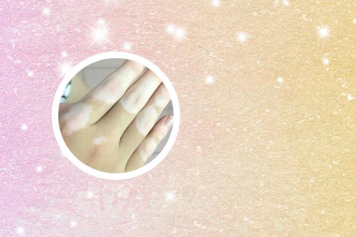 白癜风能不能吃龙虾尾