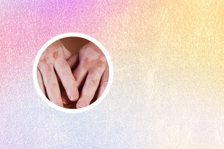 白癜风眉毛变白治好的案例