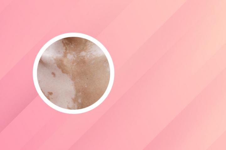 给白癜风的看病给报销吗