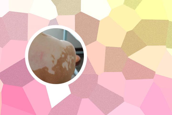 白癜风免费贴牌代理