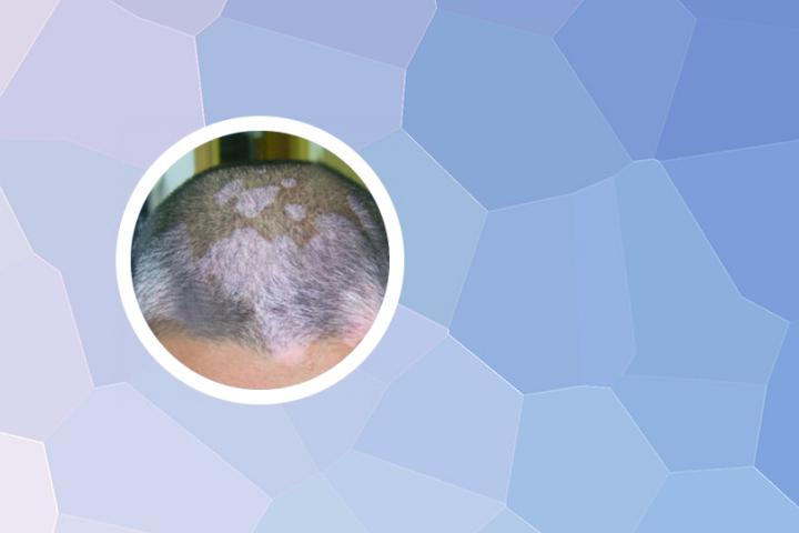 白癜风病纳入医保没有