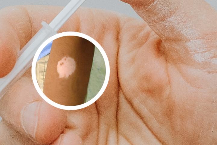 羊肉白癜风克星
