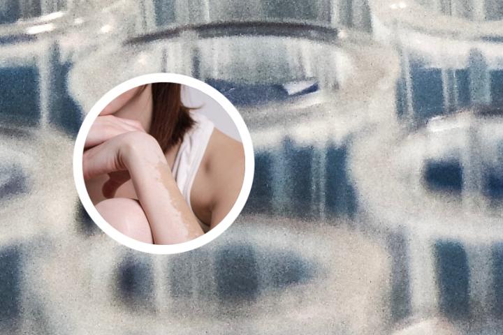 白癜风治疗补贴的申请