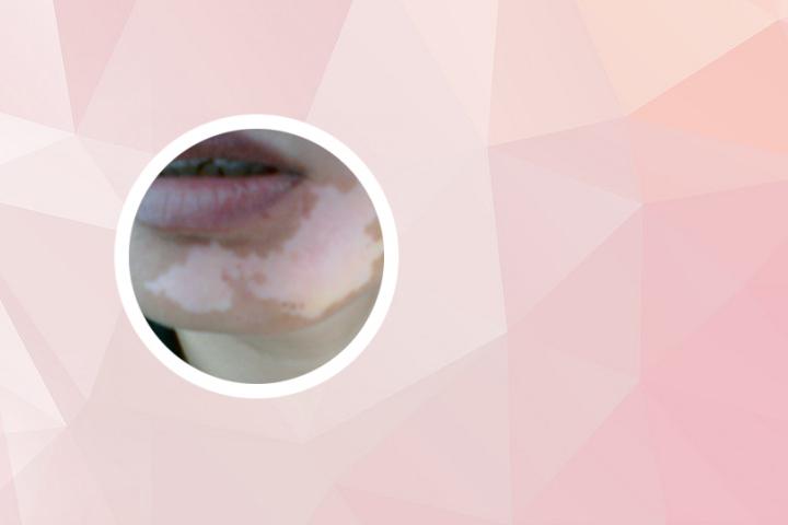 白癜风美女怀孕