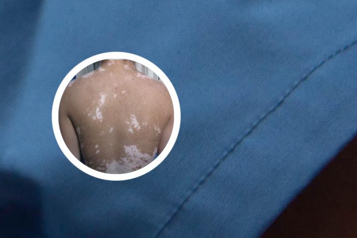 青衣附院白癜风科专家
