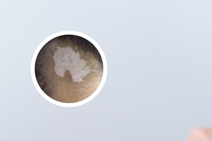 白癜风什么类型好治