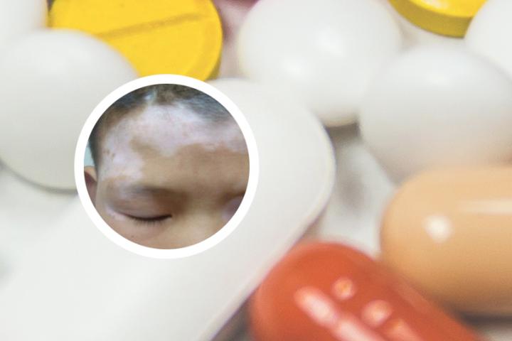 白癜风激光治疗有危害吗