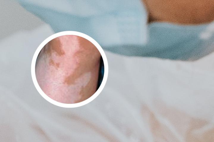 婴儿有换白癜风可能吗
