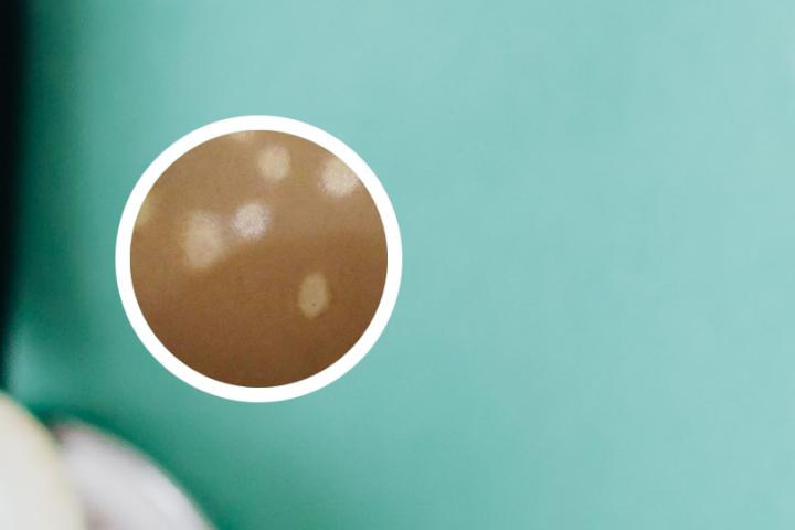 茋枣颗粒治疗白癜风吗