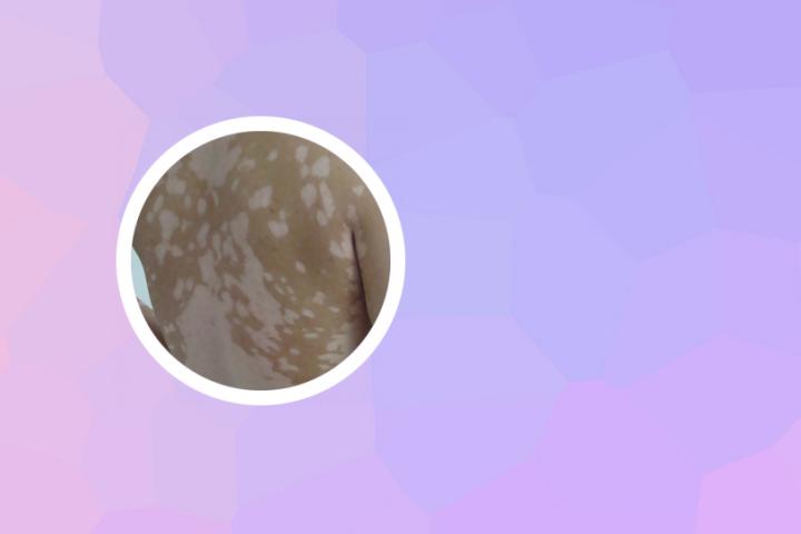 白癜风是不是一定要切除