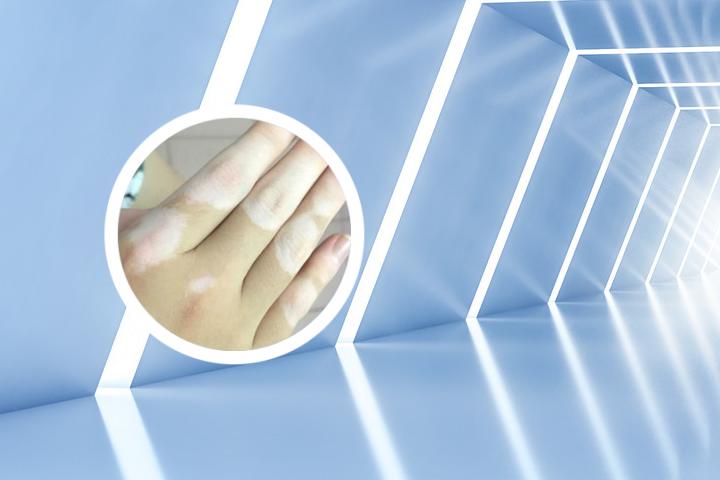 白癜风护理学笔记