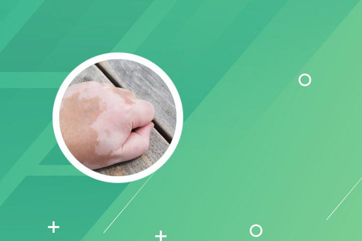 白癜风经常泡脚有什么好处
