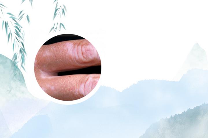 白癜风患者可以每天洗头吗