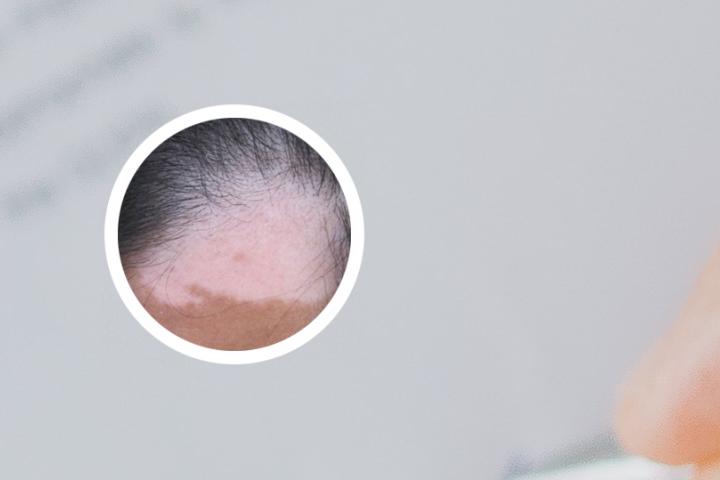 八卦与白癜风