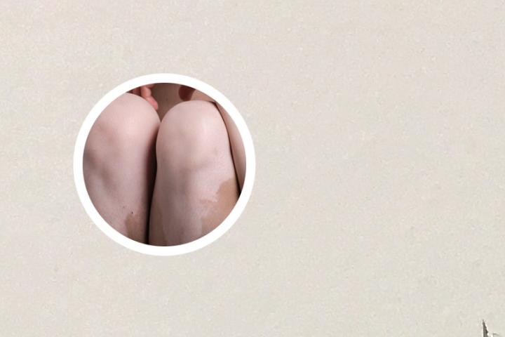 陕西白癜风女孩