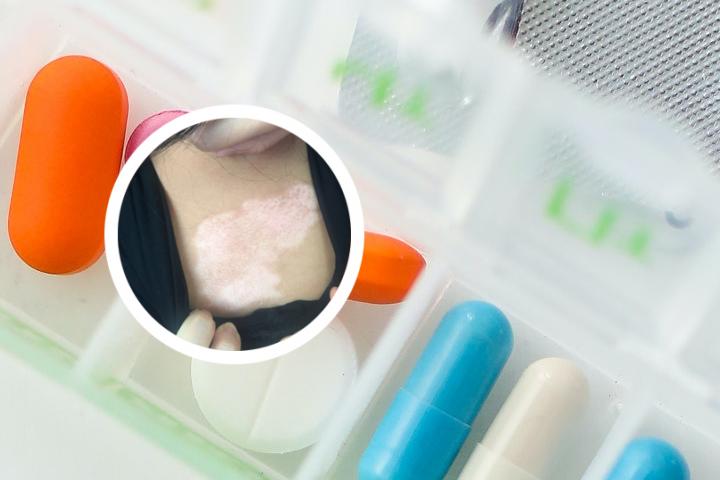 白癜风病人可以吃葱姜蒜吗